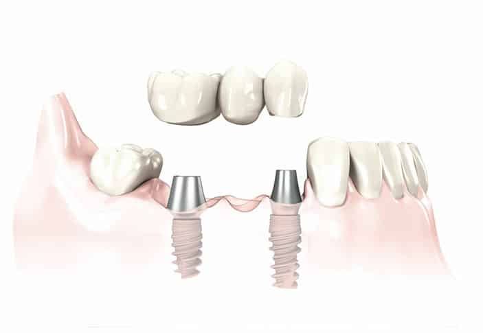 Dental Implants